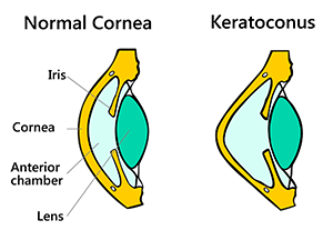 Schematic diagram showing normal cornea and cornea with keratoconus. by Madhero88 (CC-BY-SA-3.0), via Wikimedia Commons